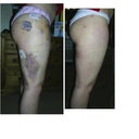 before,week after,2months after